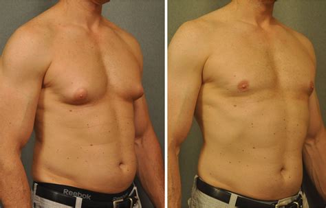 6 thg 4, 2020. . Chest fat removal